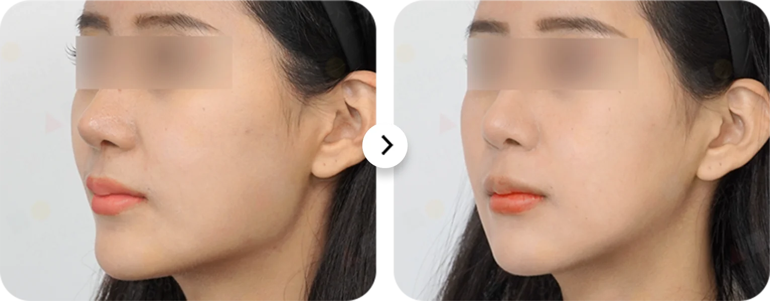 Эрүүний шугам лифтинг мэс заслын үр дүнд нүүрний контур хэрхэн өөрчлөгдөж, эрүүний хэлбэр сайжирсныг харуулсан зураг.