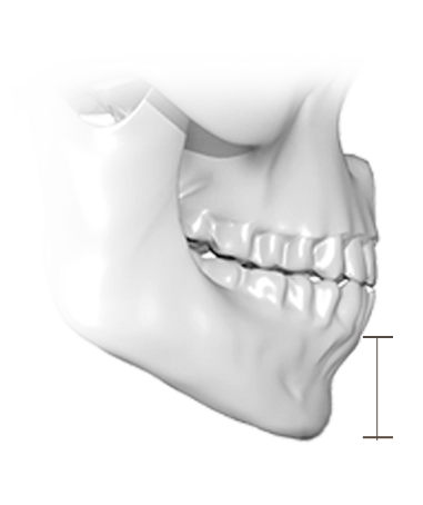 Эрүүний шугам лифтинг мэс заслын 3D дүрслэл нь эрүүний хэлбэрийг тодотгож, нүүрний доод хэсгийн контурыг сайжруулахад чиглэдэг.