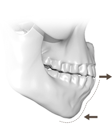 Эрүүний шугам лифтинг мэс заслын үр дүнд эрүүний хэлбэр хэрхэн өөрчлөгдөж байгааг харуулсан зураг.