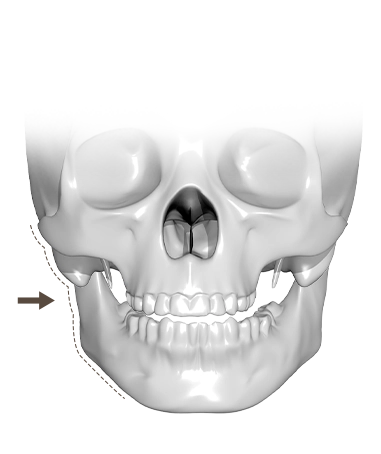 Эрүүний шугам лифтинг мэс заслын үр дүнд хүрэхийн тулд эрүүний ясыг өөрчлөх анатомийн дүрслэл.