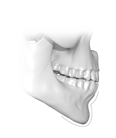 Эрүүний шугам лифтинг мэс заслын үр дүнд эрүүний хэлбэр сайжирч, нүүрний доод хэсгийн контур тодорч, залуу харагдах боломжтой.