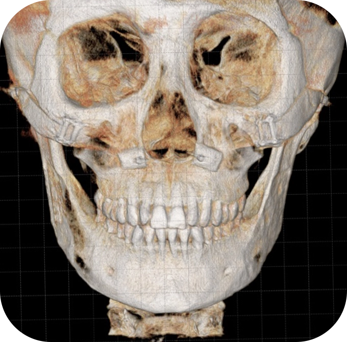 3D рентген зурагт эрүүний шугам лифтинг болон нүүрний ясны бүтцийг харуулсан дүрслэл.