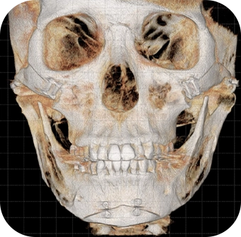 3D рентген зураг дээр эрүүний шугам лифтинг мэс заслын дараах нүүрний ясны бүтцийг харуулсан дүрслэл.
