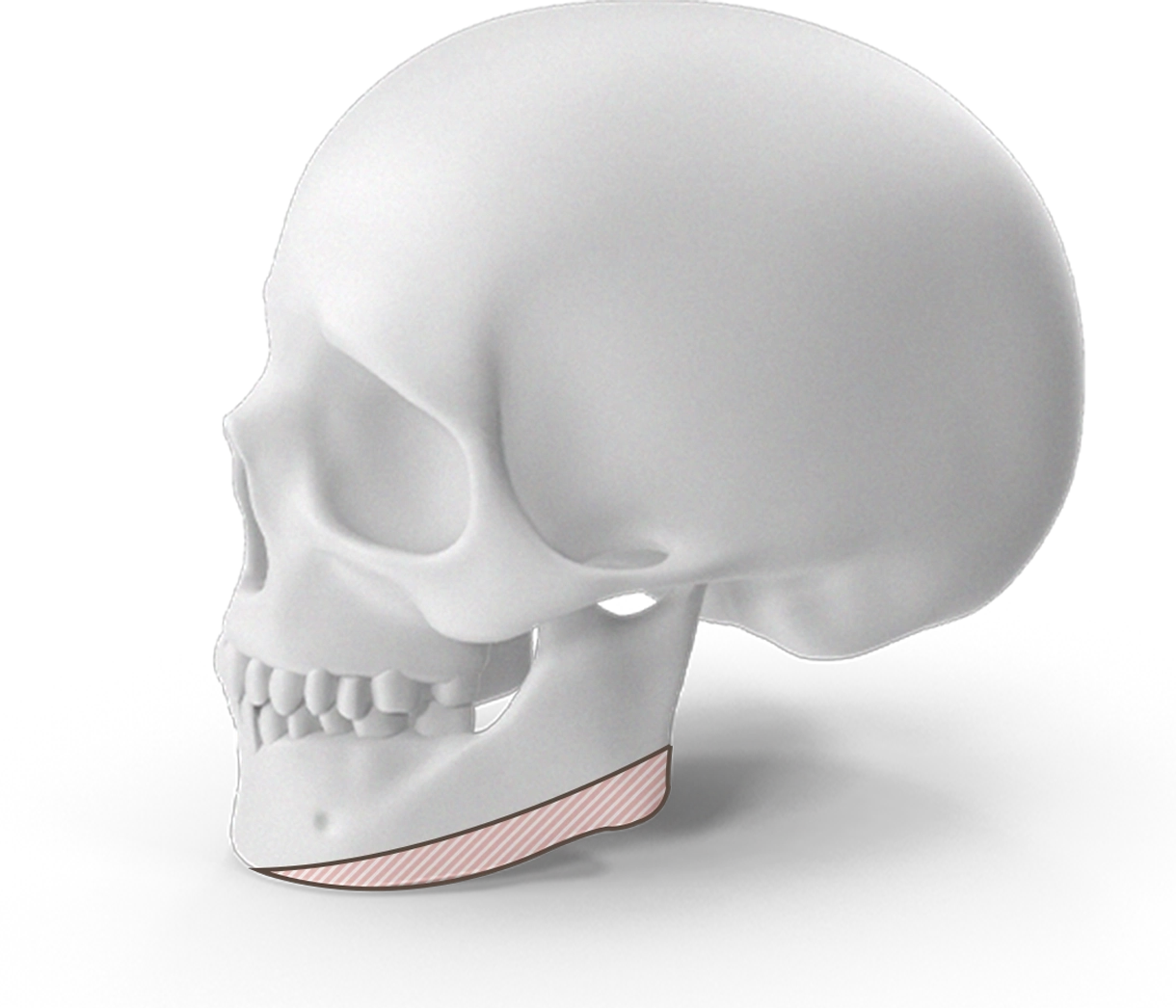 Эрүүний шугам лифтинг мэс заслын үр дүнд эрүүний хэлбэр хэрхэн өөрчлөгдөж байгааг харуулсан хүний гавлын зураг.