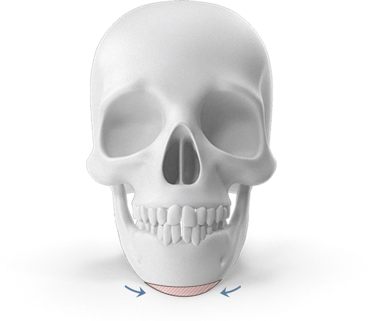 Эрүүний шугам лифтинг мэс заслын үед эрүүний хэлбэрийг өөрчлөхийн тулд эрүүний доод хэсгийг хэрхэн зүсэж авахыг харуулсан хүний гавлын зураг.