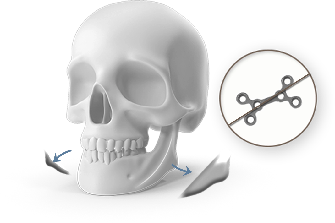 Эрүүний ясны Плюс-Минус лифтинг мэс заслын зураг. Плюс-Минус лифтинг нь эрүүний хэлбэрийг өөрчлөх, нүүрний контурыг сайжруулах зорилготой.