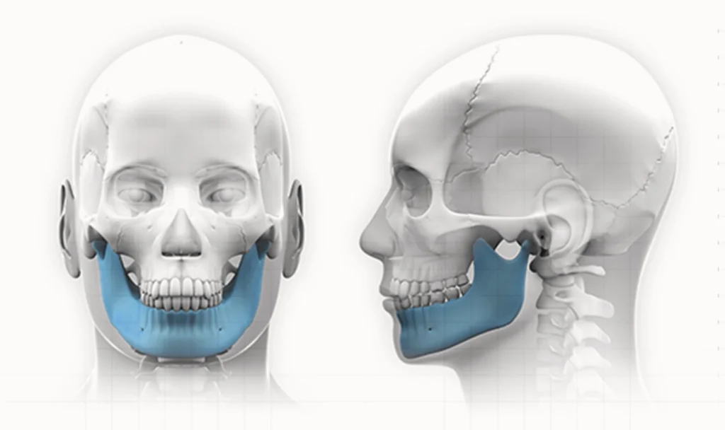 Эрүүний шугам лифтинг мэс заслын хүний гавлын ясны эрүүний хэсгийг цэнхэр өнгөөр тодотгон дүрсэлсэн зураг.