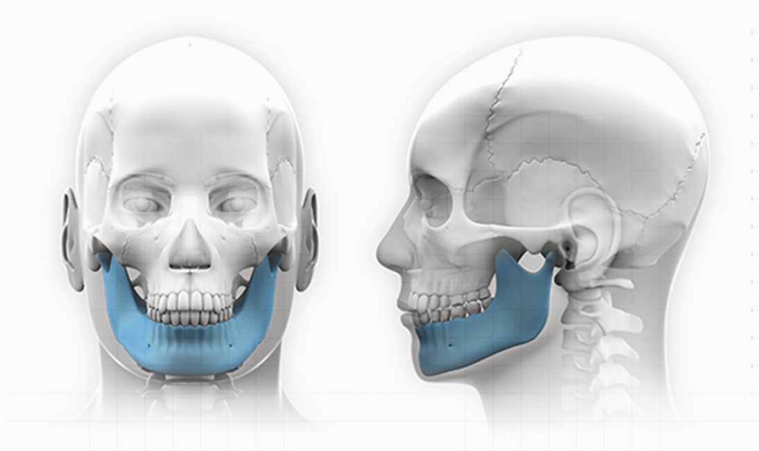 Эрүүний шугам лифтинг мэс заслын хүний гавлын ясны эрүүний хэсгийг цэнхэр өнгөөр тодотгон дүрсэлсэн зураг.