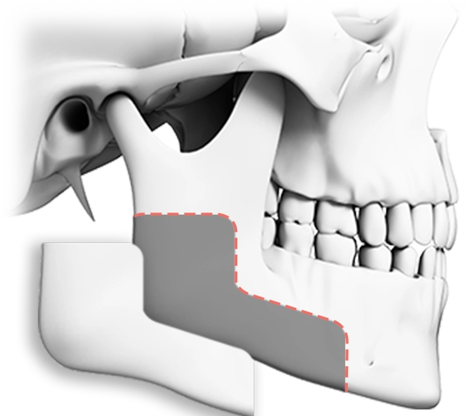 Эрүүний шугам лифтинг мэс заслын араг ясны зураг, эрүүний хэлбэрийг тодотгож, нүүрний доод хэсгийг чангалж, залуужуулах үйлчилгээтэй.