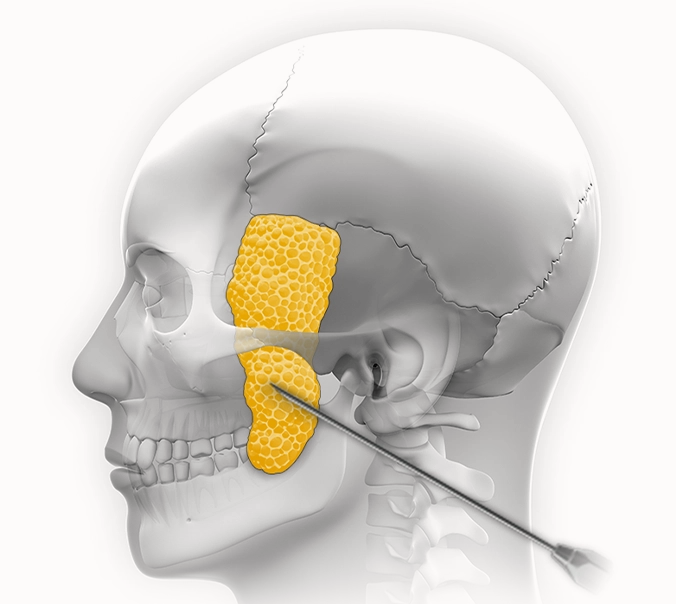 Нүүрний гүн өөхний дэвсгэрийг харуулсан зураг. Нүүрний контур, лифтинг мэс заслын үед нүүрний гүн өөхний дэвсгэрийг авч нүүрний хэлбэрийг өөрчлөх боломжтой.