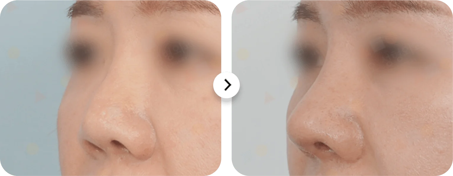 Энэ зурагт хамар засах мэс заслын үр дүнг харуулсан байна. Хамрын үзүүр болон нурууны хэлбэр өөрчлөгдсөн нь харагдаж байна.