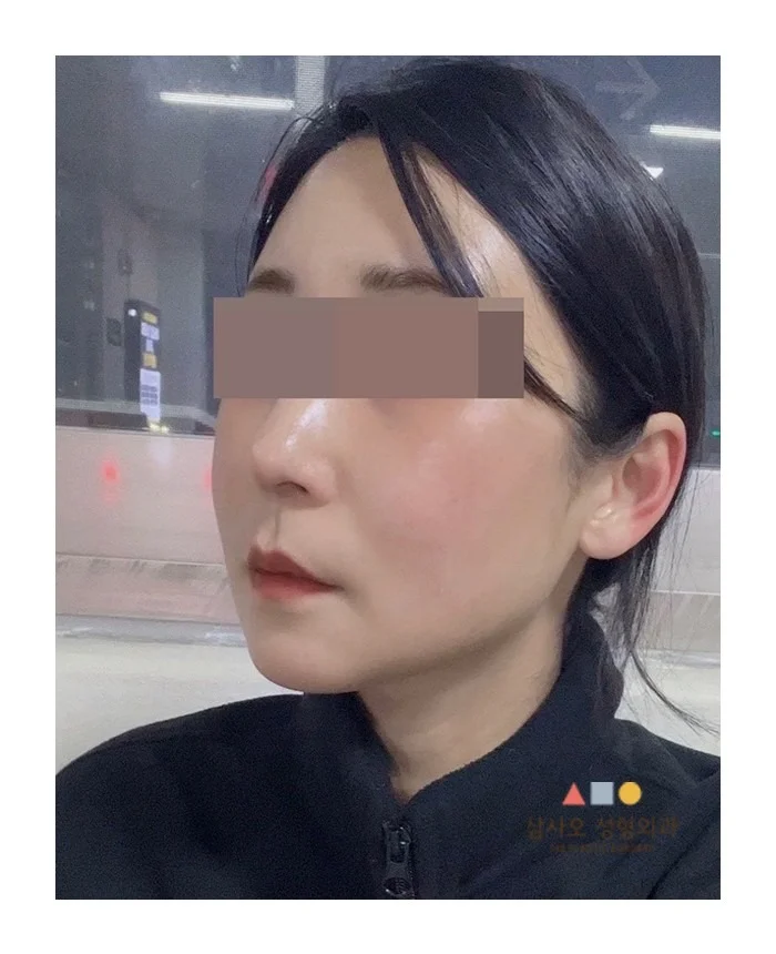 Эмэгтэй хүний хажуугийн зураг дээр нүүрний хэсгийг хаасан байна. Нүүрний контур, лифтинг мэс заслын үр дүн харагдаж байна.