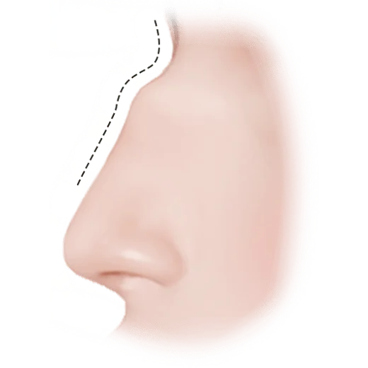Хамрын гоо сайхны мэс заслын хажуугийн дүрслэл. Хамрын мэс засал нь хамрын хэлбэр, хэмжээг өөрчлөх зорилготой гоо сайхны мэс ажилбар юм.