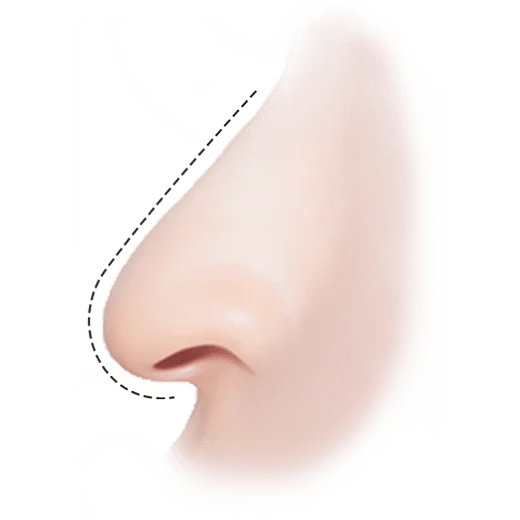 Хамрын үзүүрийг өргөх мэс заслын зураг, хамарны хэлбэрийг өөрчлөх мэс ажилбарын дараах хамарны үзүүрийн өөрчлөлтийг харуулсан зураг.