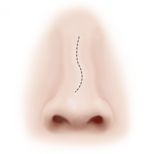 Хамрын голын хэлбэр засах мэс заслын зүслэг хаана хийгдэхийг харуулсан зураг.