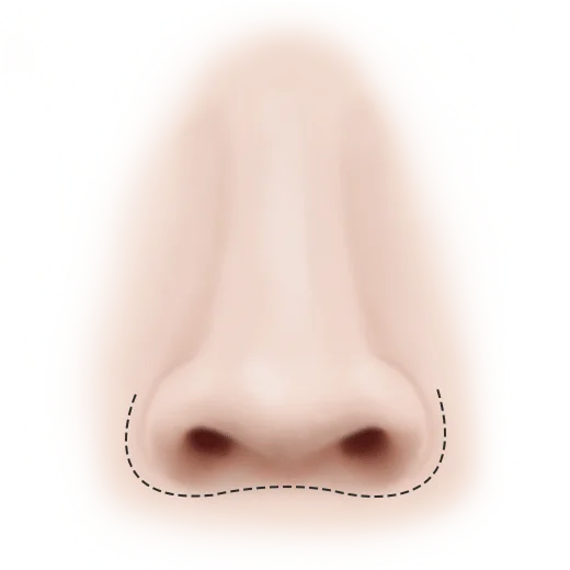 Хөндлөн зүсэлттэй уруулын доод хэсгийн нүүрний контур, лифтинг мэс заслын зураг.