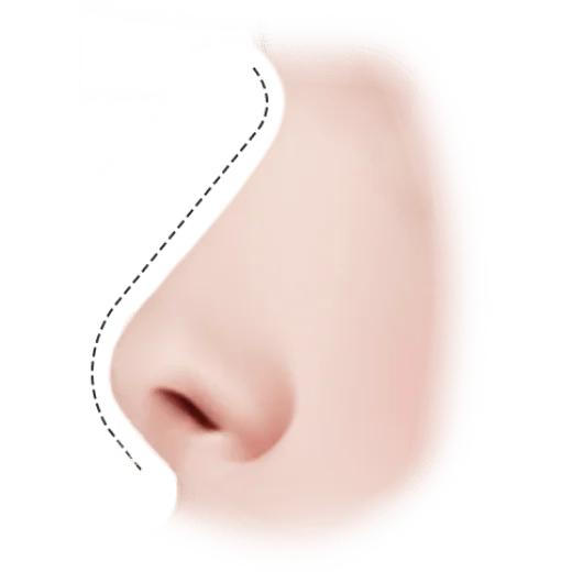 Хажуугийн харагдах байдлаар хамар болон нүүрний хажуу хэсгийг харуулсан зураг. Хамрын мэс заслын тухай ойлголт.