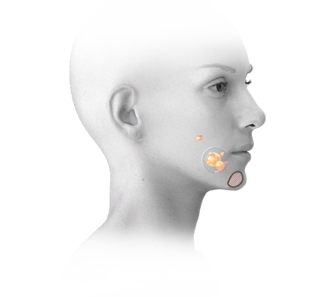 Эрүүний шугам лифтинг мэс заслын зураг, нүүрний хэлбэрийг тодотгож, өө сэвийг арилгах зорилготой.