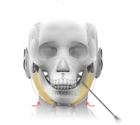 Эрүүний шугам лифтинг мэс заслын график дүрслэл. Эрүүний шугамыг тодотгох мэс ажилбарын зураг.