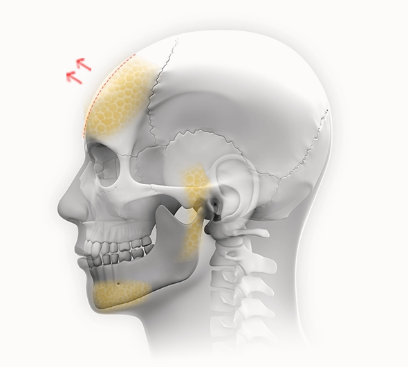 Нүүрний араг ясны хажуугийн дүрслэл, духны хэсэгт лифтинг хийх хэсгийг заасан зураг. Духны лифтинг мэс заслын үр дүнгийн тухай ойлголт өгнө.