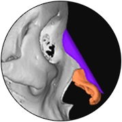 Эрүүний шугам лифтинг мэс заслын 3D дүрслэл, булчин болон арьсны өнгө ялгаатайгаар харагдаж байна.