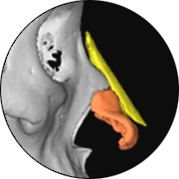 Энэ бол нүүрний контур заслын 3D дүрслэл бөгөөд хамар, эрүү, гавлын ясыг харуулсан байна.