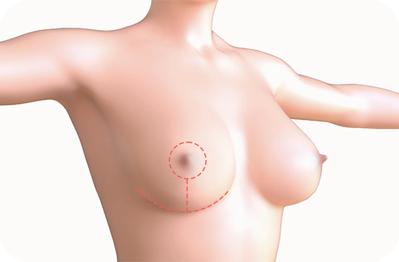 Хөхний өргөлтийн мэс заслын зурагт хөхний доод хэсэгт зүсэлт хийхээр төлөвлөж буйг харуулсан байна.