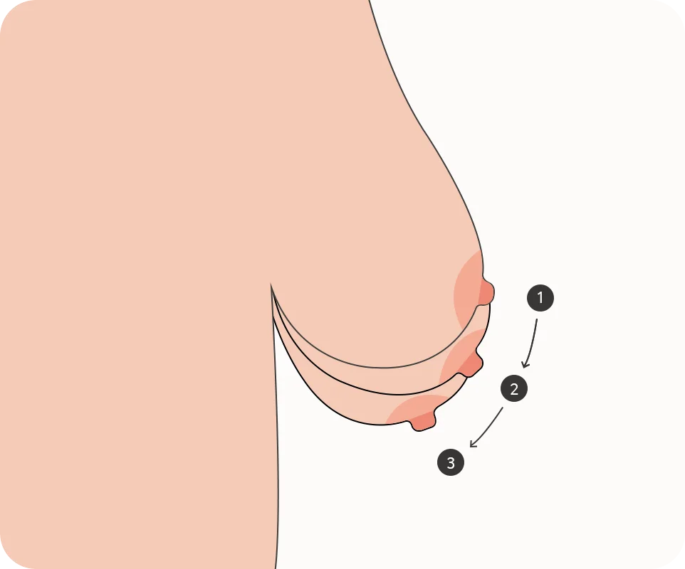 Хөх өргөх мэс заслын үе шатыг харуулсан зураг. Хөхний толгойг тойруулан зүсэлт хийж хөхний арьсыг чангалж өргөх мэс засал.