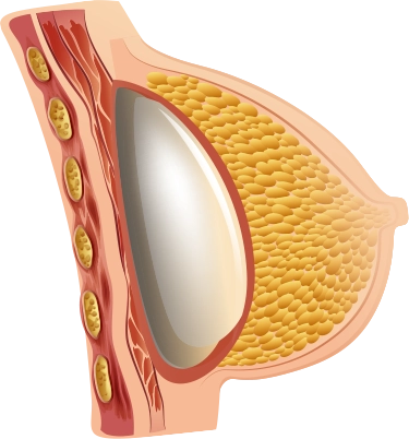 Хөхний томруулах мэс заслын дүрслэлд хөхний имплант, булчин, өөхний эд, арьсыг харуулсан хөндлөн огтлолыг үзүүлэв.