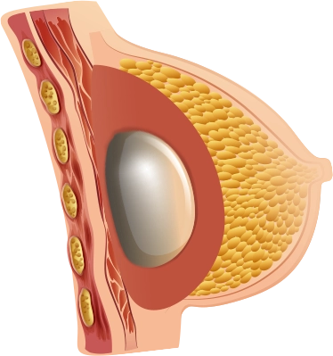 Хөхний томруулах мэс заслын зургийг харуулсан хөндлөн огтлолтой зураг. Хөхний имплант, булчин, өөхний эд, арьсыг харуулсан зураг.