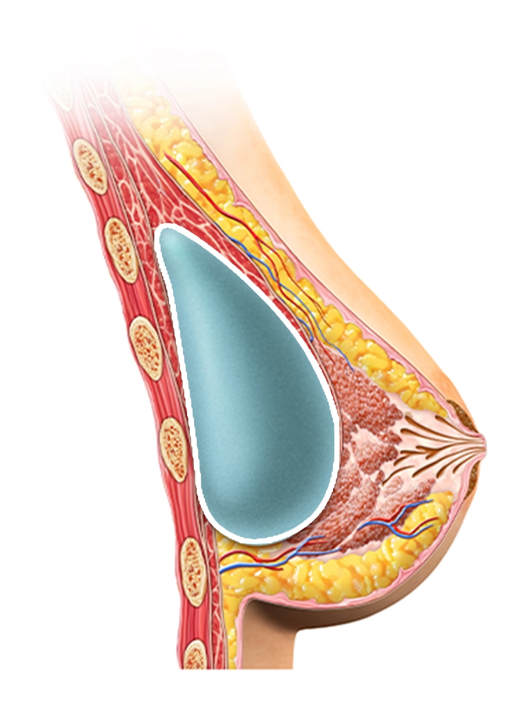 Хөх томруулах мэс заслын зурагт хөхний имплантыг хэрхэн байрлуулсныг харуулсан хөндлөн огтлолын дүрслэл.