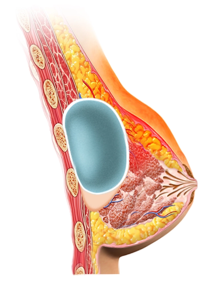 Хөхний томруулах мэс заслын анатомийн зурагт булчин, өөхөн эд, хөхний имплант зэргийг харуулсан хөндлөн огтлолтой дүрслэл.