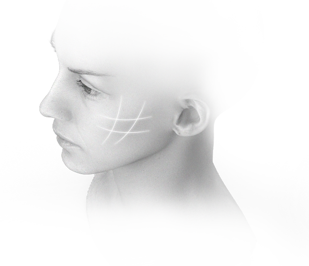 Эмэгтэй хүний нүүрний хажуугийн зураг дээр нүүр өргөх мэс заслын тэмдэглэгээг харуулсан байна.