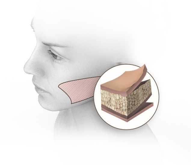 Эрүүний шугам лифтинг мэс заслын үеийн арьсны бүтцийг харуулсан зураг. Эрүүний шугам лифтинг нь нүүрний доод хэсгийн арьсыг чангалж, залуужуулах зорилготой.