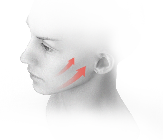 Эрүүний шугам лифтинг мэс заслын үр дүнд нүүрний арьс чангарч, унжсан хэсэг дээш өргөгдөж байгааг харуулсан зураг.