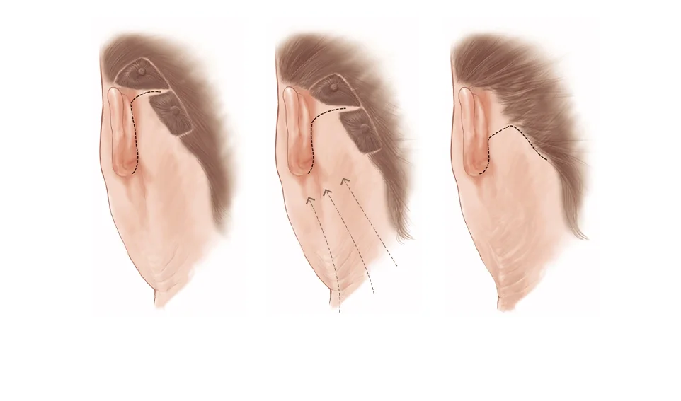 Эрүүний шугам лифтинг мэс заслын зургийг харуулсан зураг. Эрүүний шугам лифтинг нь нүүрний арьсыг чангалах, унжсан арьсыг өргөх зорилготой гоо сайхны мэс засал юм.