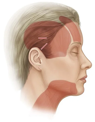 Нүүрний булчингийн байршлыг харуулсан зураг, нүүр өргөх мэс заслын зүслэг болон өргөх хэсгийг дүрсэлсэн байна.