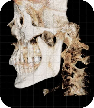 Энэ бол эрүүний шугам лифтинг мэс заслын 3D дүрслэл бөгөөд нүүрний яс болон хүзүүний бүтцийг харуулсан рентген зураг юм.