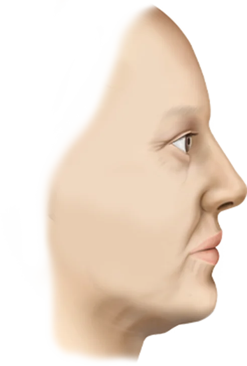 Энэ зурагт нүүрний контур засах болон эрүүний шугам өргөх мэс заслын дараах хажуугийн дүрсийг харуулж байна.