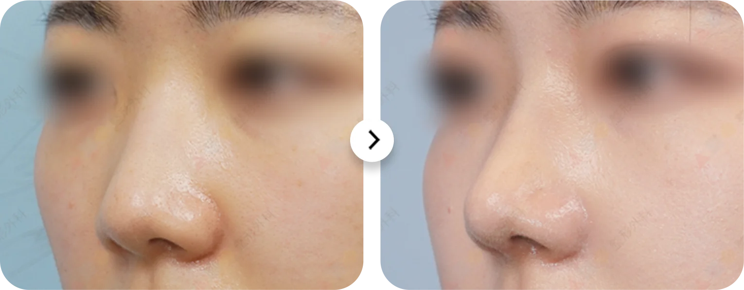 Энэ зурагт хамар өргөх мэс заслын үр дүн харагдаж байна. Хамрын хэлбэр сайжирч, царайны ерөнхий төрх илүү тэнцвэртэй болсон байна.