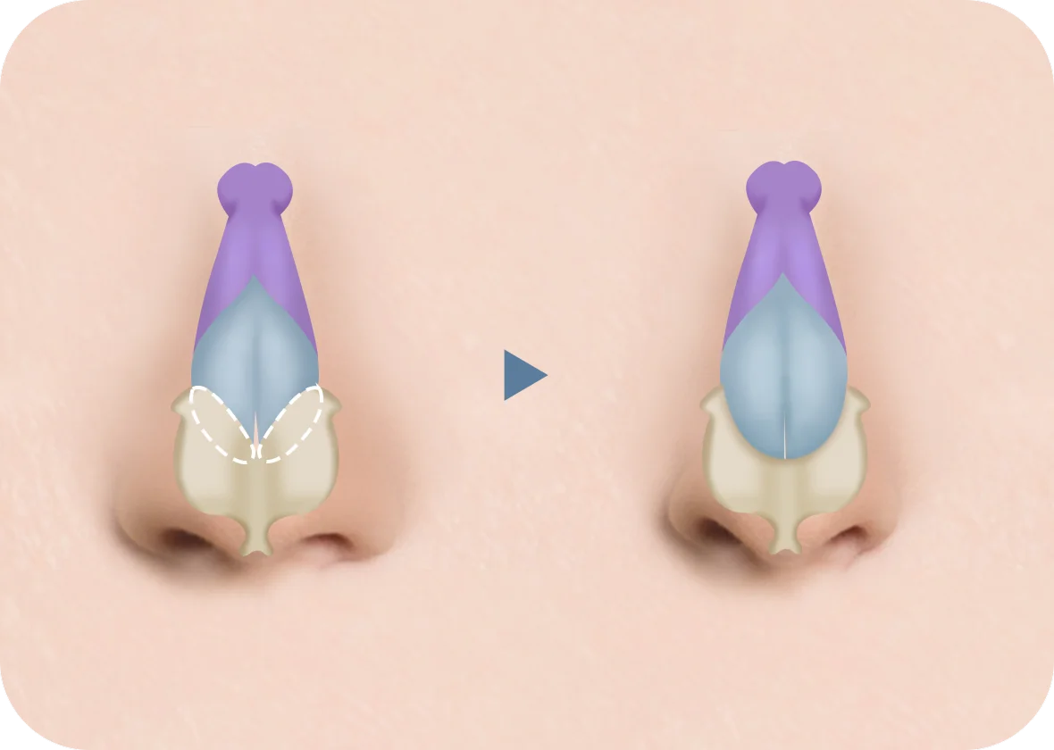 Хамрын үзүүрийг өргөх мэс заслын зураг, хамар урт, нарийхан харагдах хагалгааны график дүрслэл.