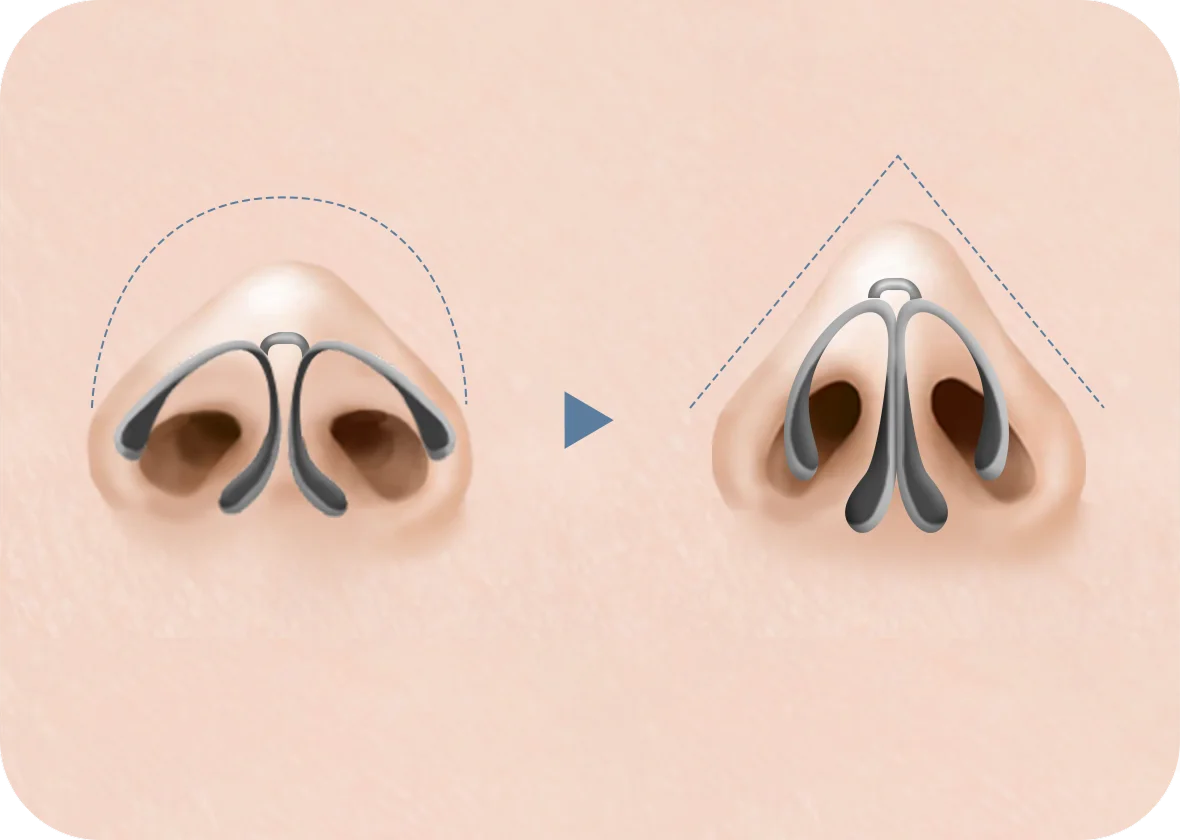 Хамрын үзүүрийг өргөх мэс заслын зургийг харуулсан бөгөөд хамрын хэлбэрийг өөрчлөхийн тулд мөгөөрсний суулгацыг хэрхэн байрлуулж байгааг харуулсан байна.