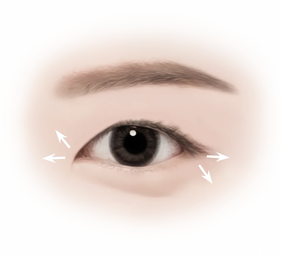 Нүдний доод хэсгийн арьсыг чангалах мэс заслын зураг, нүдний доод унжсан арьсыг засаж, нүдний доод хэсгийн арьсыг чангалах үйлдэл.