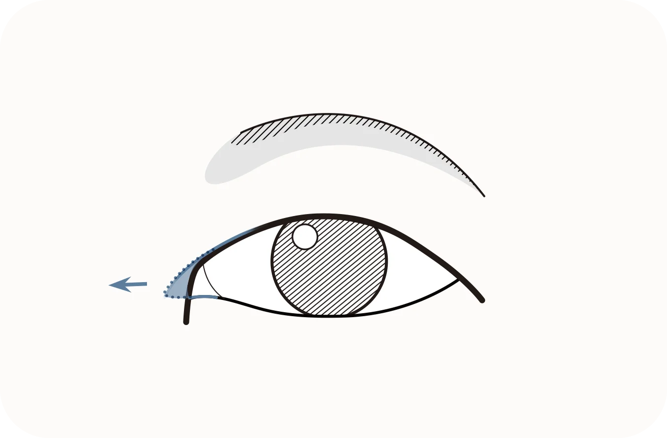 Зургийг нүд, хөмсөгний хамт харуулсан бөгөөд дээд зовхины арьсыг тайрах хэсгийг цэнхэр өнгөөр тоймлон үзүүлэв. Дээд зовхины мэс засал.