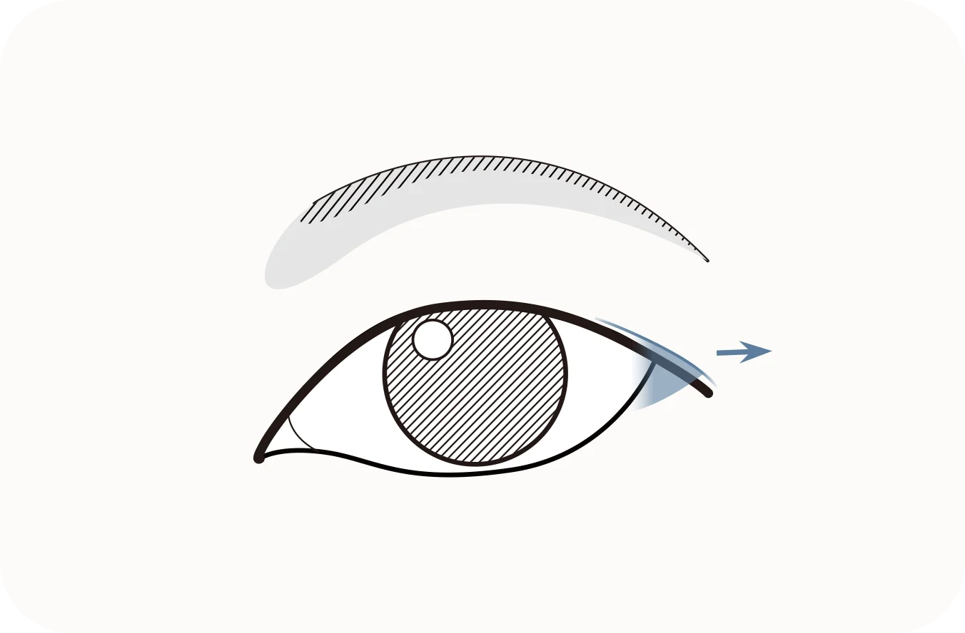 Зургийн зурагт дээд зовхины өөхийг авах хагалгааны зургийг харуулсан байна. Дээд зовхины өөхийг авах хагалгаа нь зовхины өөхийг арилгах мэс ажилбар юм.