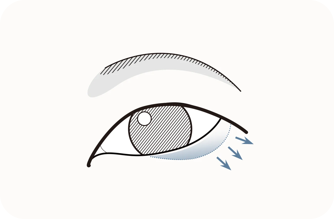 Нүдний доод зовхины унжилтыг засах мэс заслын зураг. Доод зовхины унжилтыг засах мэс засал нь нүдний доод хэсгийн унжсан арьсыг өргөж, залуу харагдах боломжийг олгоно.