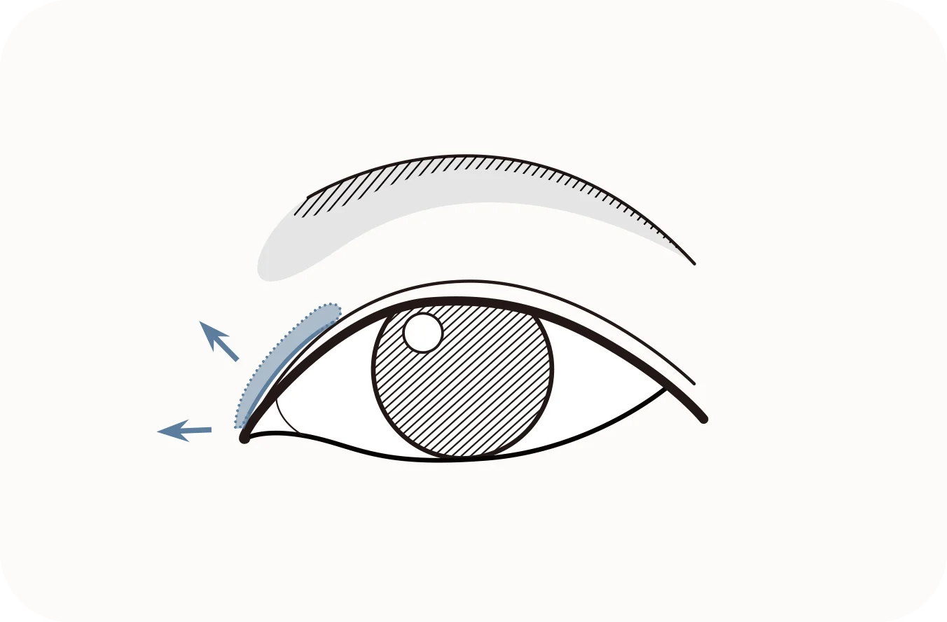 Зургийг нүдний дээд зовхины мэс заслын схемийг харуулсан бөгөөд хөмсөгний дээгүүр зүсэлт хийж, дээш өргөх аргыг дүрсэлжээ.