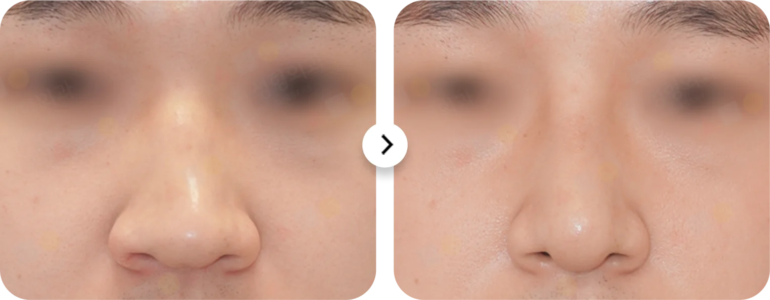 Энэ зурагт хамар өргөх мэс заслын үр дүнг харуулсан байна. Хамрын хэлбэр, төрхийг өөрчилсөн харагдаж байна.