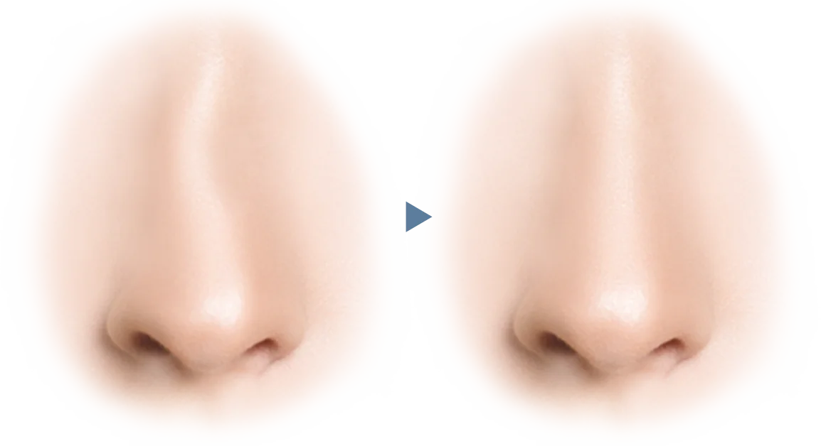 Хамрын үзүүрийг өргөх мэс заслын хамарны хэлбэрийг өөрчлөх визуал зураг.