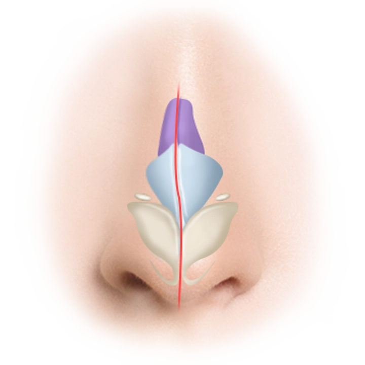 Хамрын үзүүрийг өргөх мэс заслын үе шатыг харуулсан зураг. Хамрын хэлбэрийг засах мэс ажилбарын схемчилсэн дүрслэл.